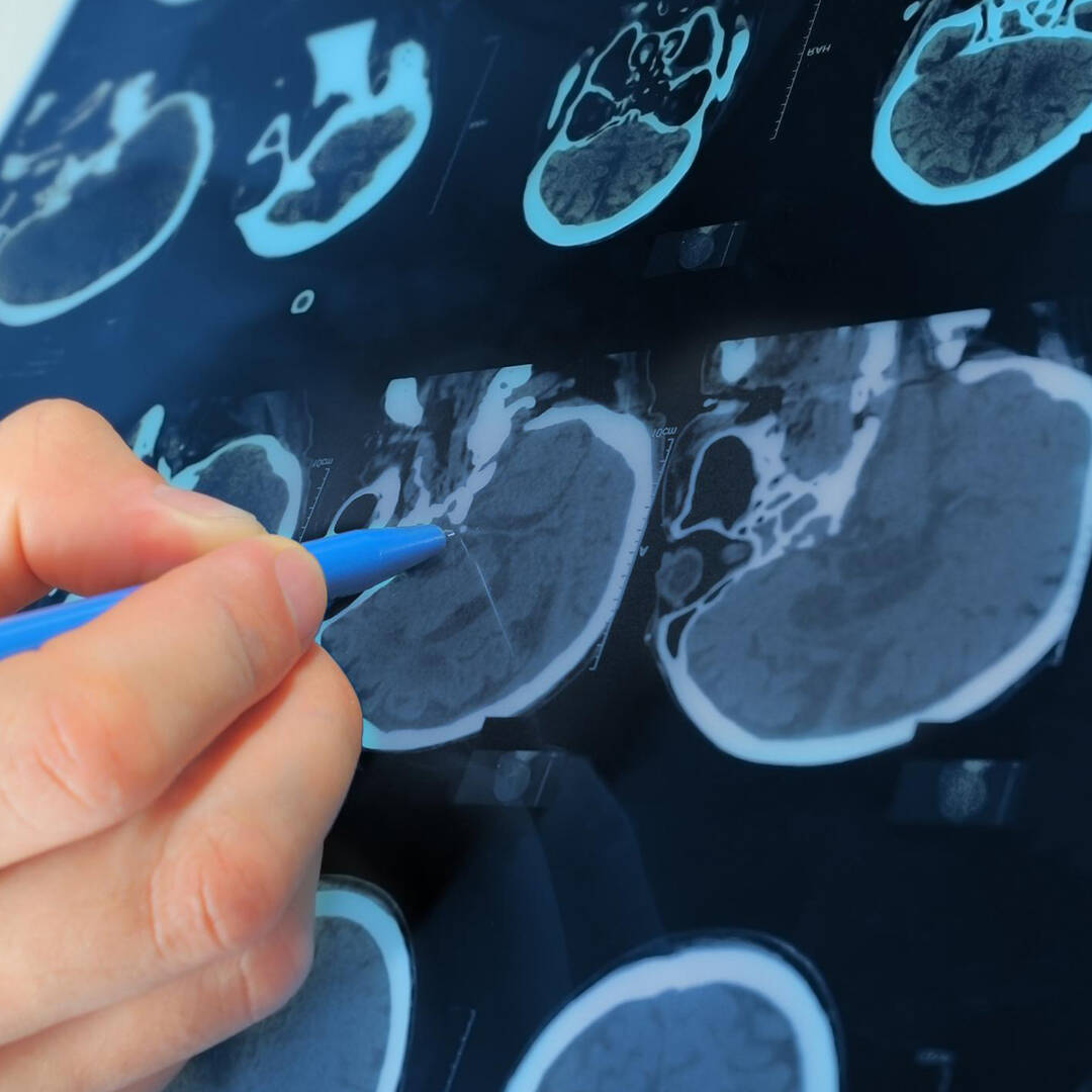 A close up of an MRI machine printout of a human head, with a person pointing to a spot with their pen