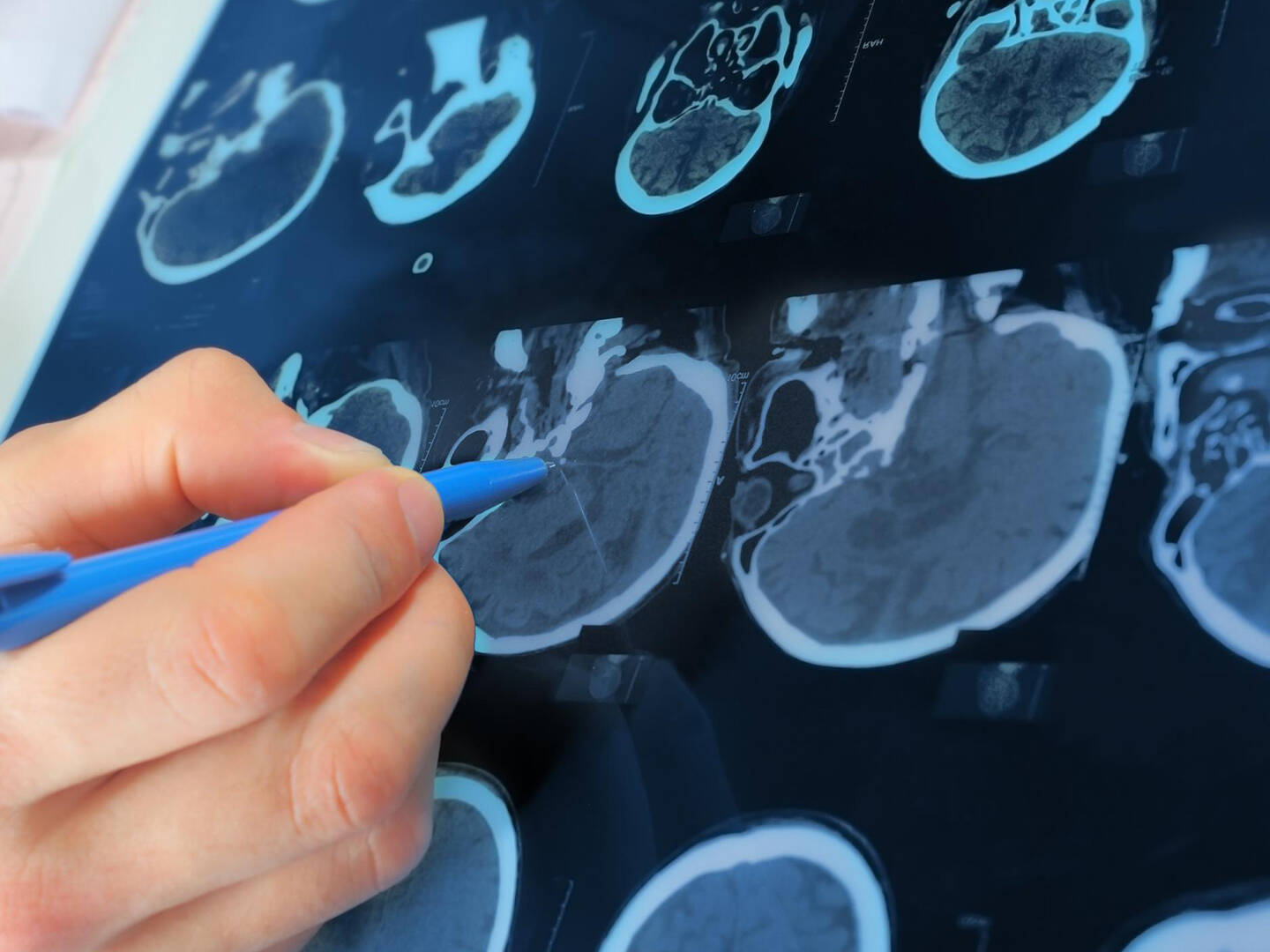 A close up of an MRI machine printout of a human head, with a person pointing to a spot with their pen