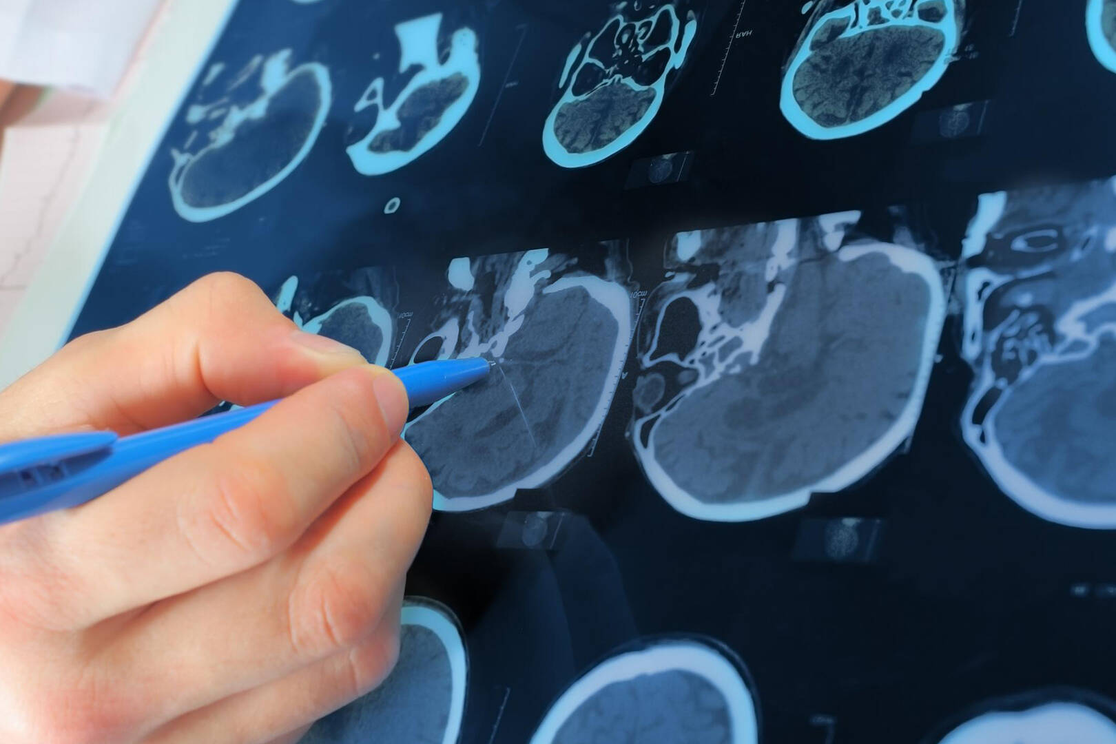 A close up of an MRI machine printout of a human head, with a person pointing to a spot with their pen
