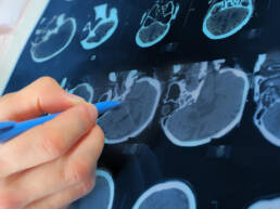A close up of an MRI machine printout of a human head, with a person pointing to a spot with their pen